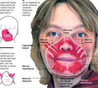 The evolution of the first face transplant The evolution of the first face transplant